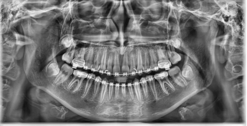 3D Imaging of full set of teeth